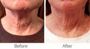 MilfordMD Skin Care Product Line | Neck Therapy 239
