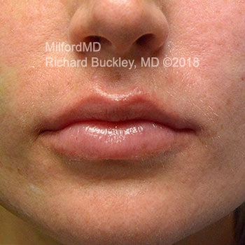 Restylane Lip Augmentation Case #36138 - After Photo