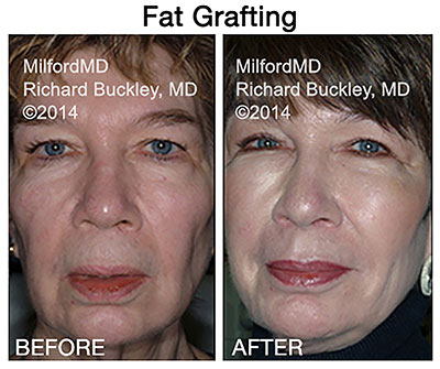 Before and after image of Dr. Richard E. Buckley’s client of a fat transfer to the face procedure.