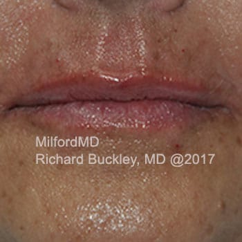 After Photo of Lip Augmentation at MilfordMD