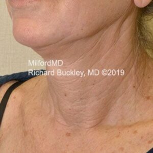 After Photo of Surgical Neck Lift