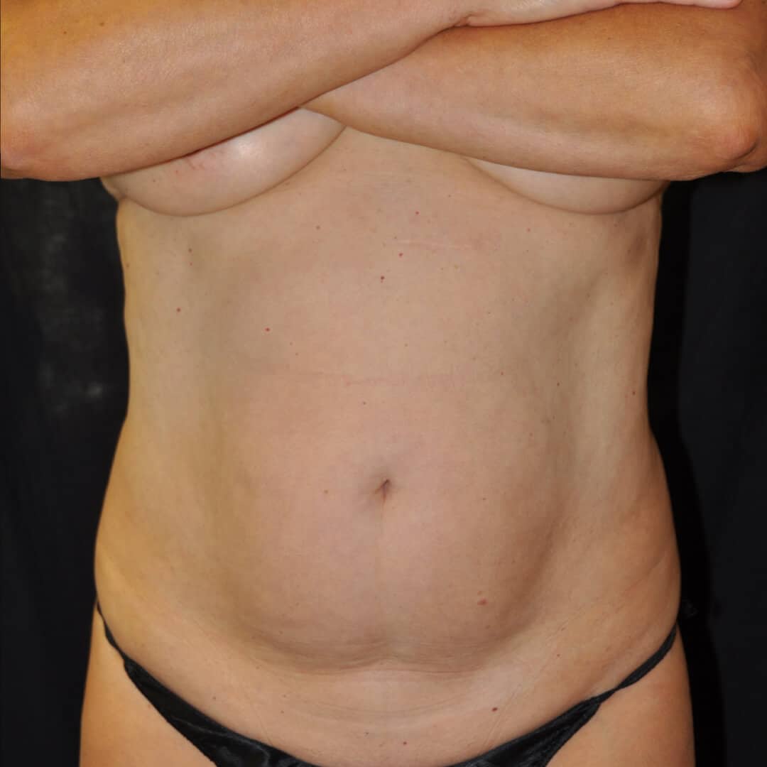 16598 laser lipo front before