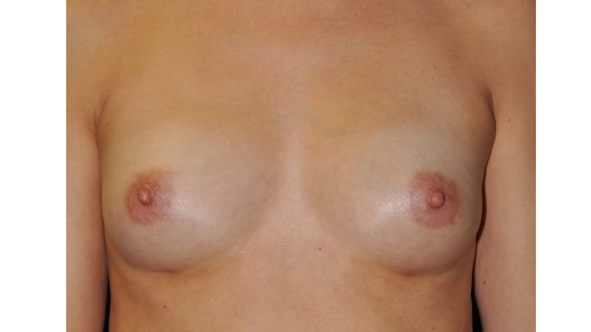Case35676 aft breast augmentation front after