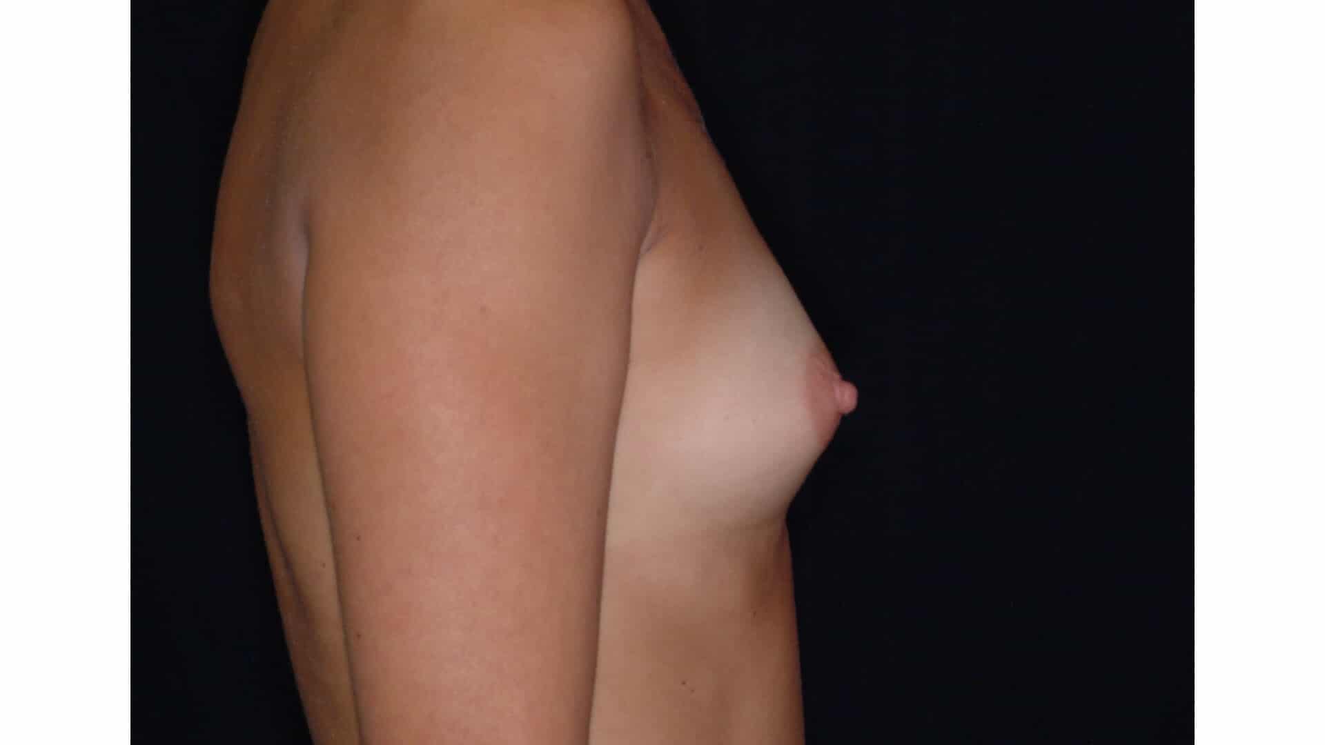 Before: BREAST AUGMENTATION AFT – CASE #35676