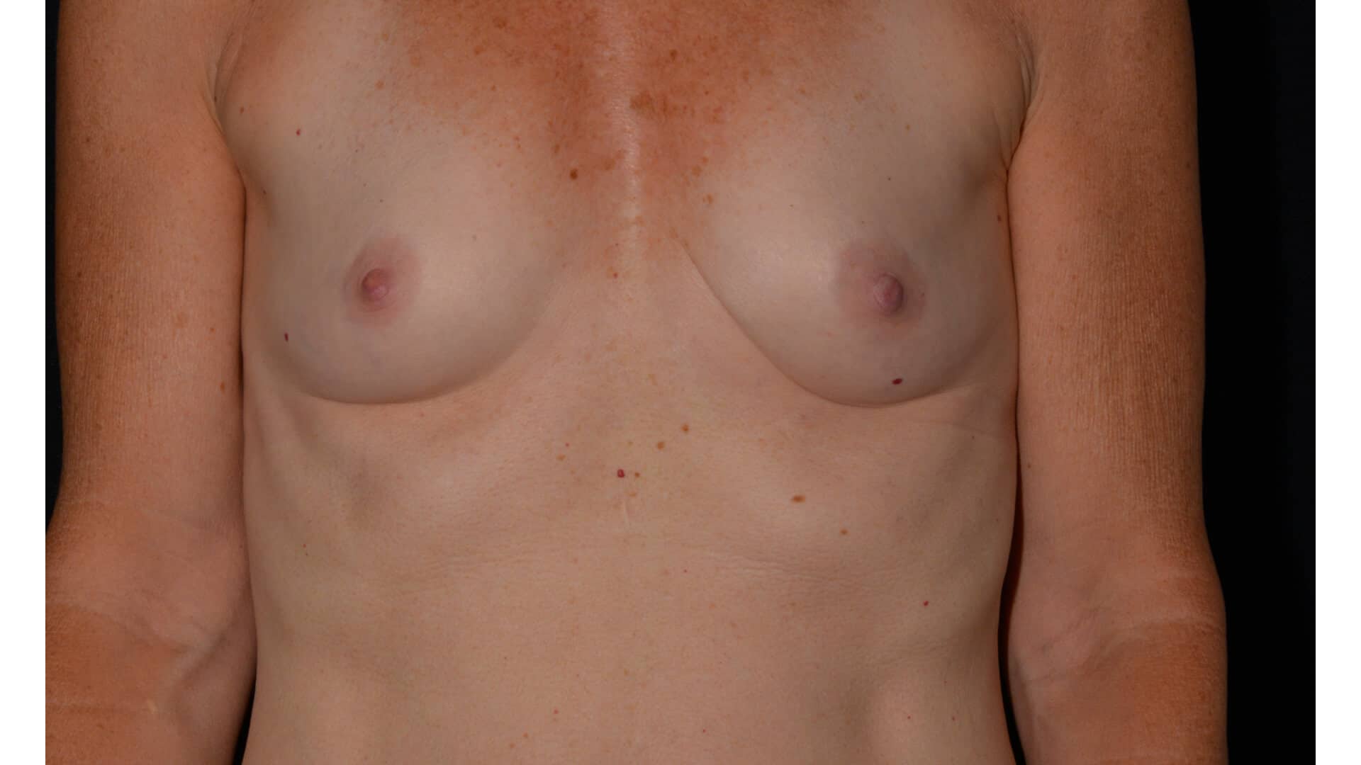 Case 35672 Sub Fascial Breast Augmentation with Silicone front before