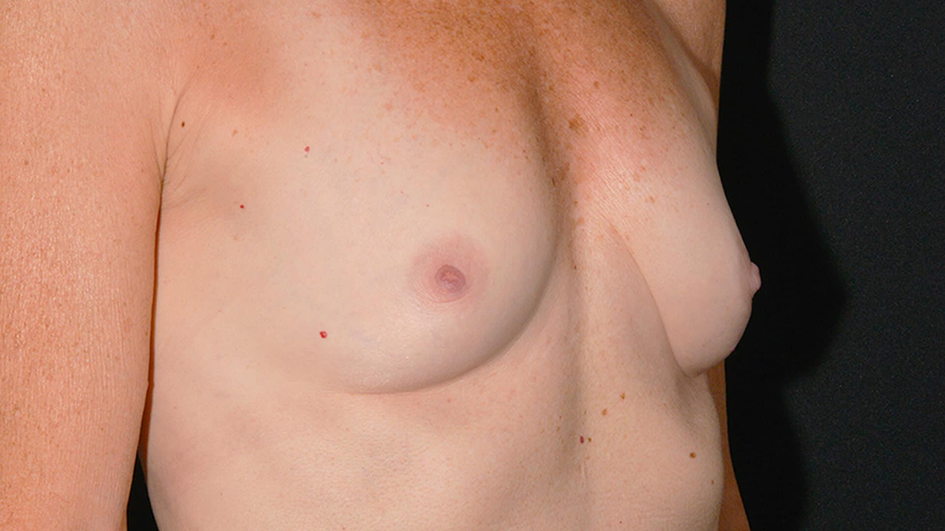 Before: BREAST AUGMENTATION – CASE #35675