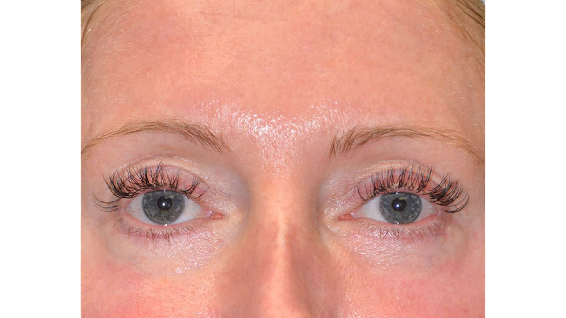Case 35737 Lower Eyelid Pinch Blepharoplasty After