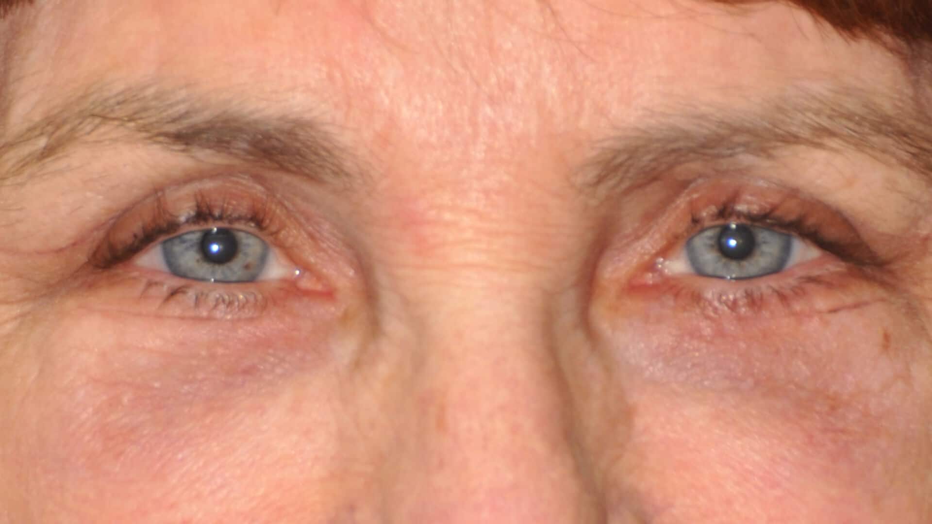 , Blepharoplasty (Eyelid Lift) – Upper