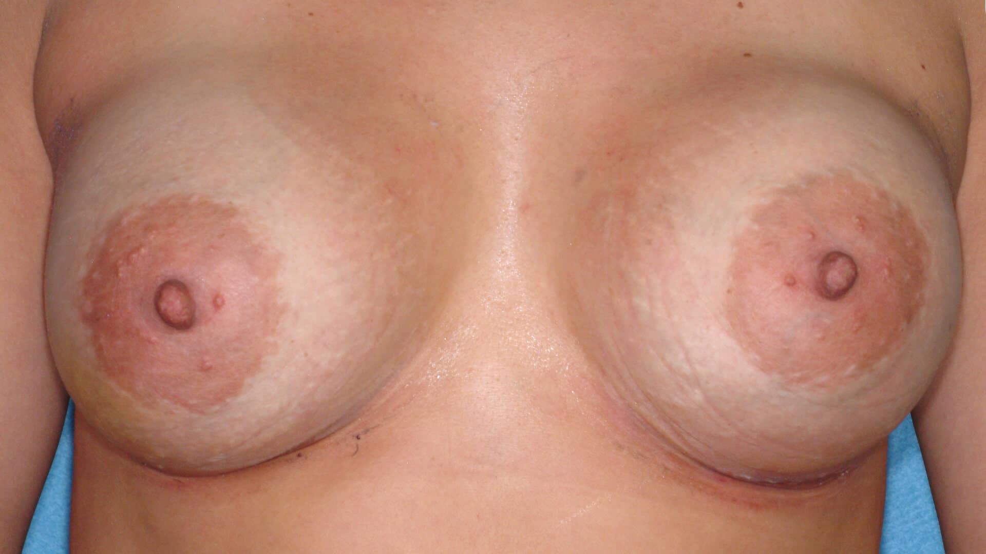 Case 35822 375cc silicone breast augmentation after