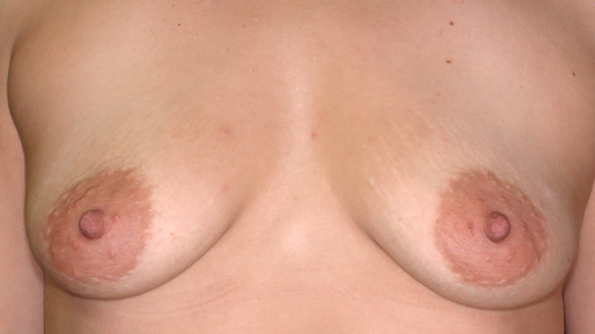 Case 35822 375cc silicone breast augmentation before