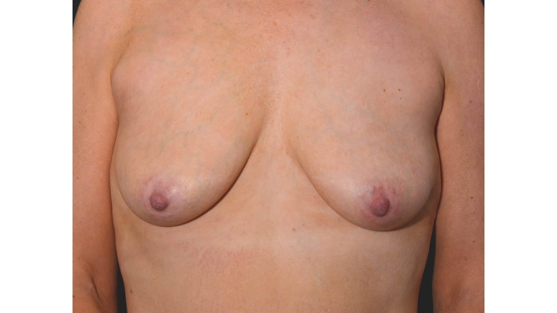 Case 35826 breast augmentation Front before