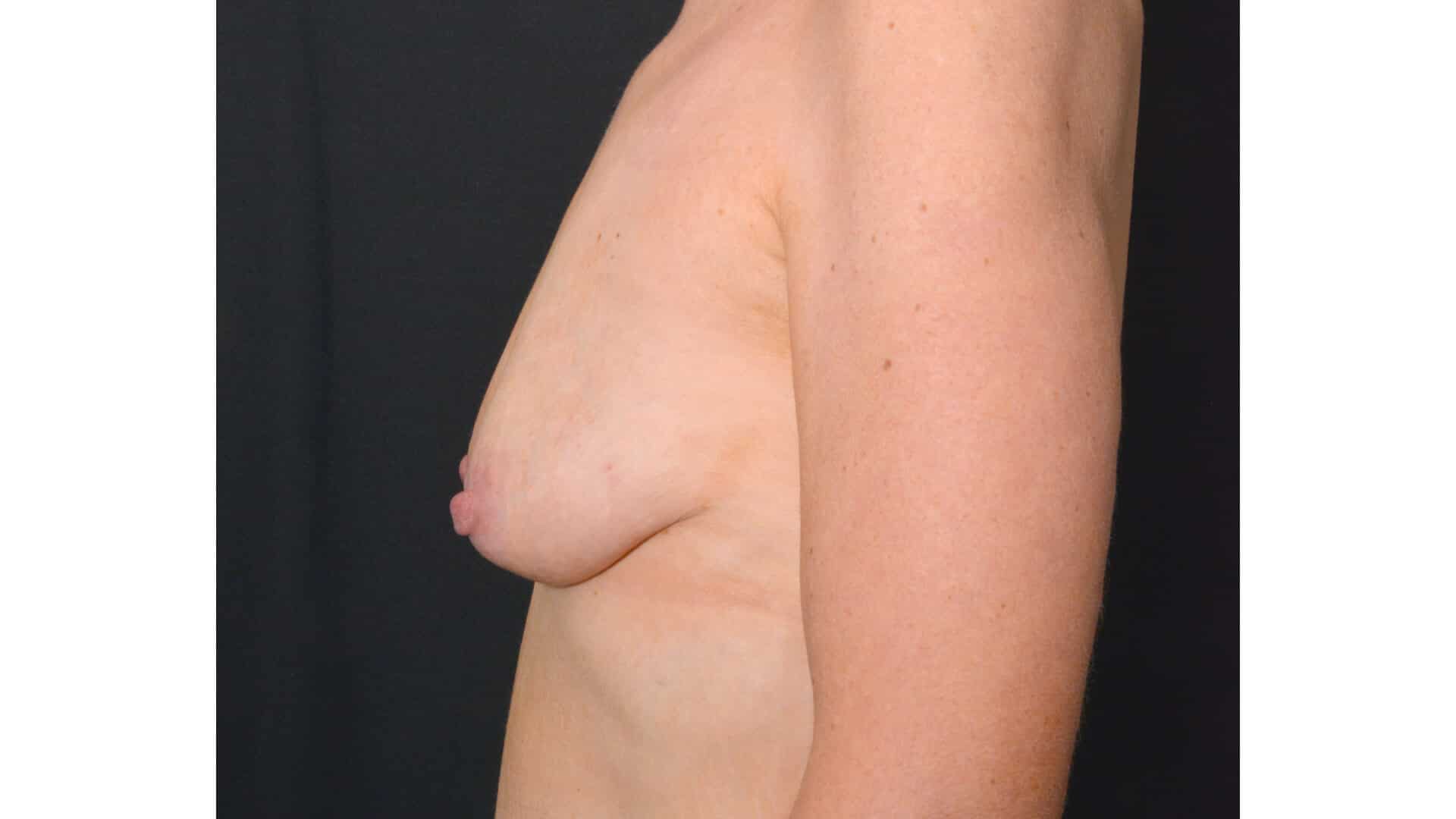 Before: BREAST AUGMENTATION – CASE #35826