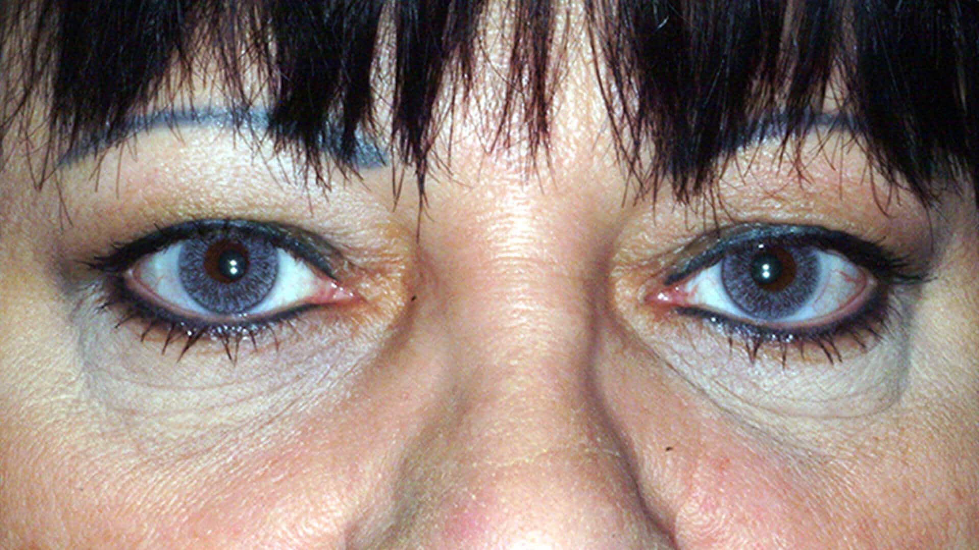 Case 38575 Blepharoplasty Upper Eyelid Tightening Before