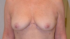 After Breast Reduction by Liposuction
