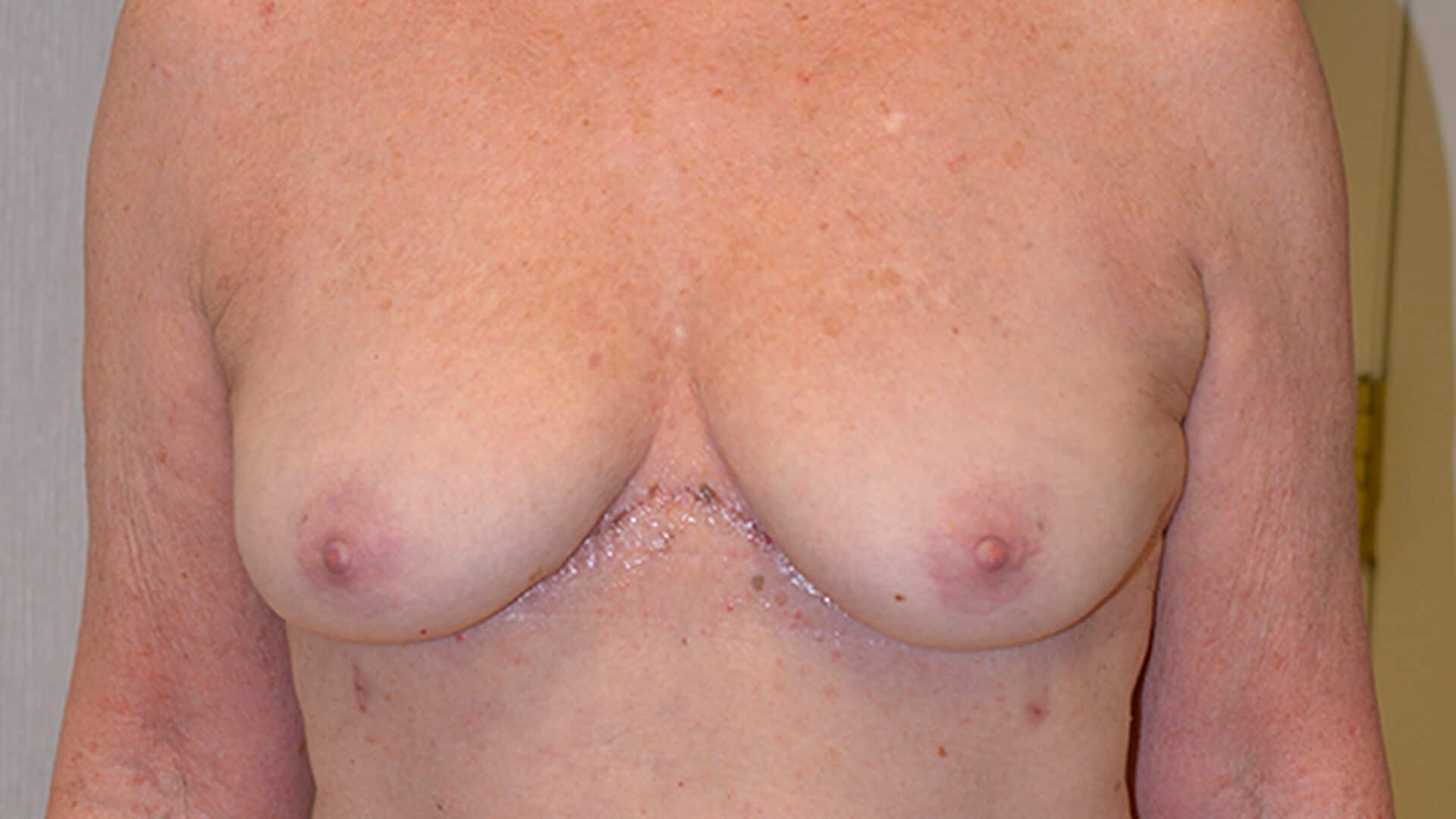 After: BREAST AUGMENTATION – CASE #62521