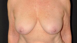 Before Breast Reduction by Liposuction