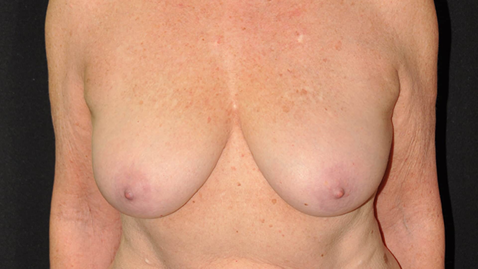 Before: BREAST AUGMENTATION – CASE #62521