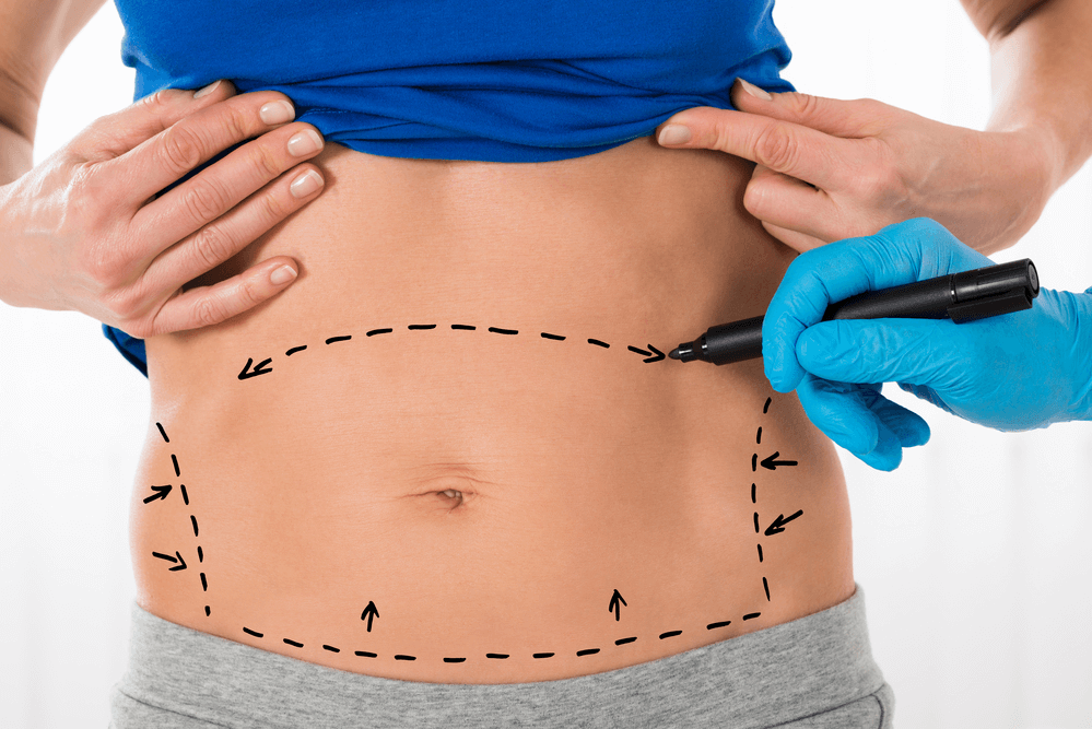 Tummy Tuck Treatment in Milford, PA | Milford MD Cosmetic Dermatology