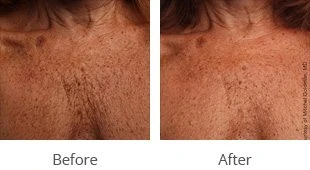 Treating Chest Wrinkles At Any Age With Ultherapy - Radiance Skincare &  Laser Medspa