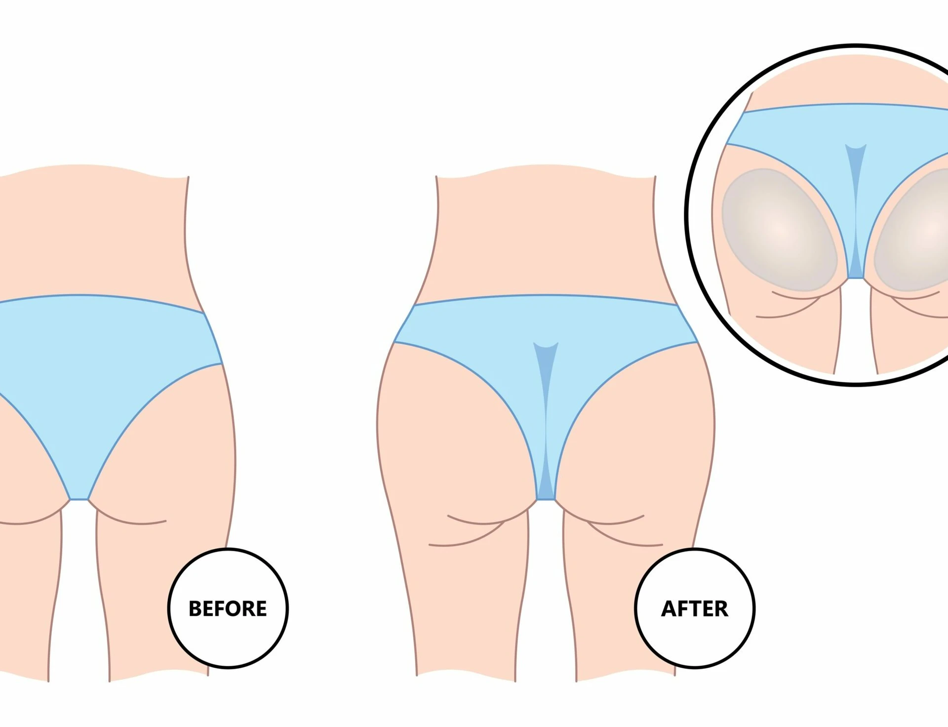 Shaping garments to tighten the abdomen, lift the buttocks, and get ri