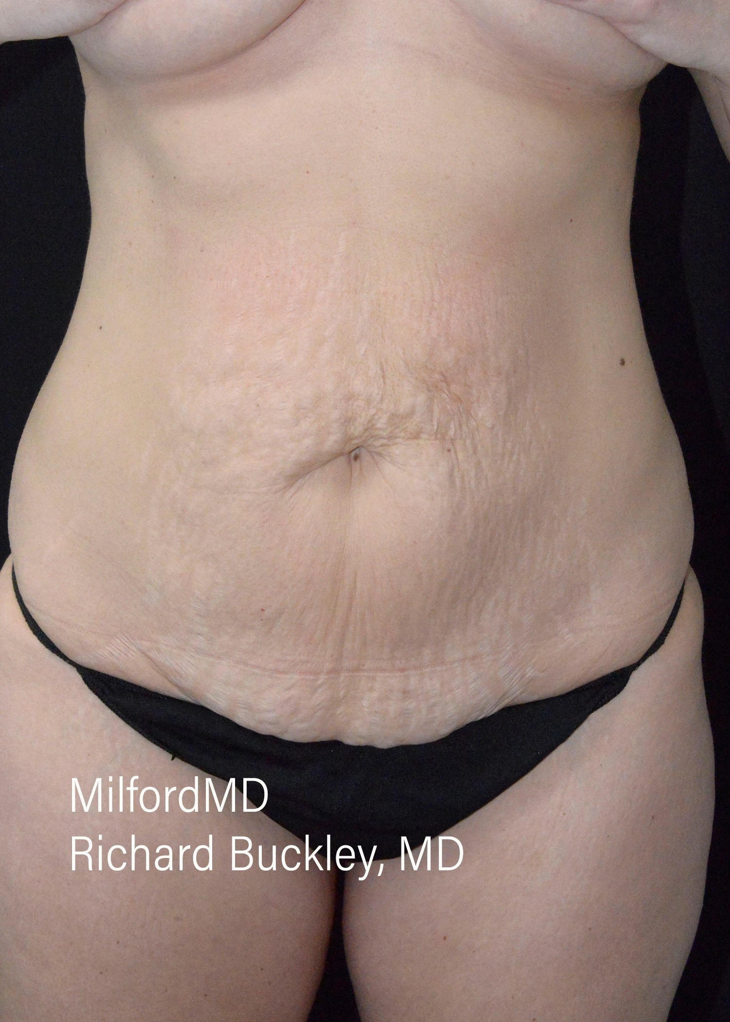 Reverse Abdominoplasty Before And After Photos
